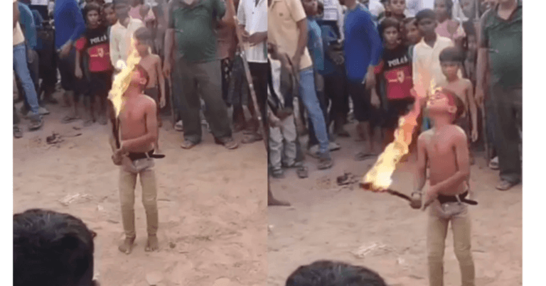 બાળકે આગને હલકામાં લઈને મોટી ભૂલ કરી, પછી થયું કઈક આવું, તેને જીવનભર યાદ રહેશે. Untitled 14